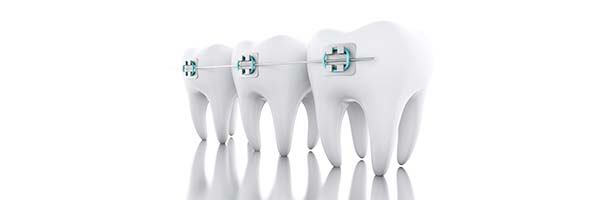 Dental Brace