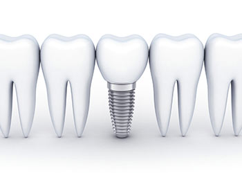 best dental implant in miranda